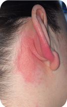 Irritant Dermatitis