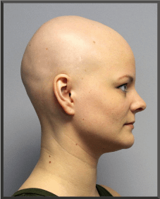 Alopecia Totalis