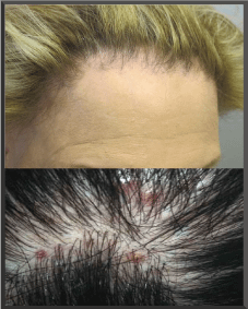 Cicatricial Alopecia