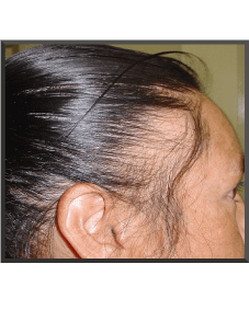 Traction Alopecia