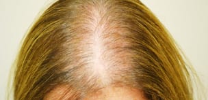 Female Pattern Hair Loss