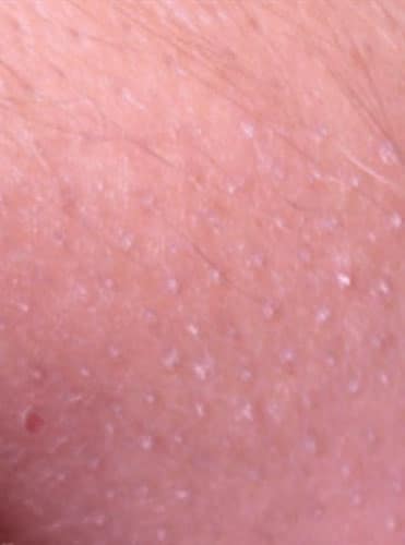 Alopecia - Hair Conditions Alopecia - Hair Conditions