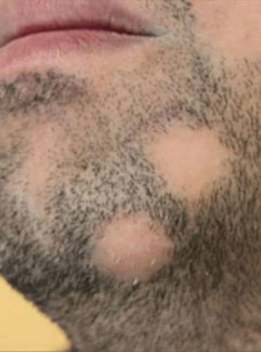 Alopecia - Hair Conditions Alopecia - Hair Conditions