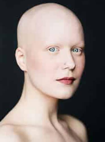 Alopecia - Hair Conditions Alopecia - Hair Conditions