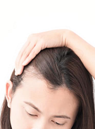 Alopecia - Hair Conditions Alopecia - Hair Conditions