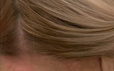 Getting On Top Of Scalp Psoriasis
