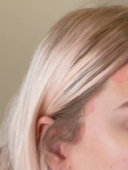 scalp psoriasis