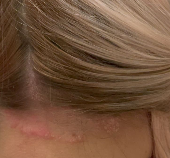 Getting On Top Of Scalp Psoriasis
