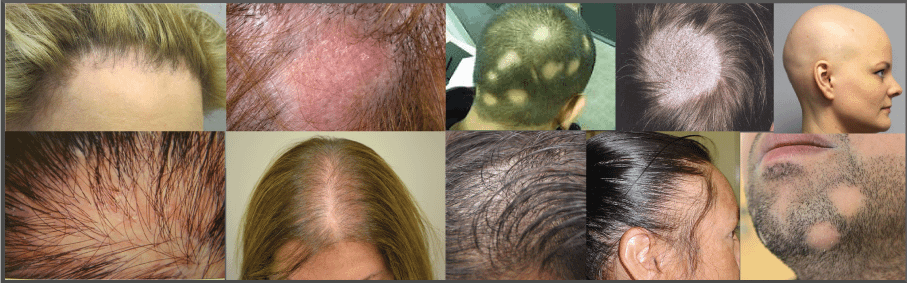 Alopecia