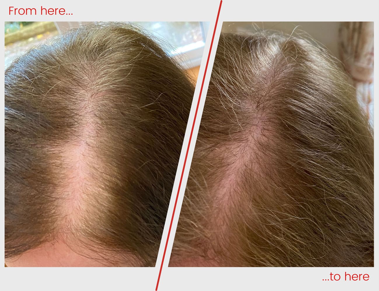 Tricoextra Before & After