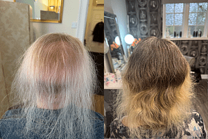 Lady showing hair growth results after 5 months of treatment.