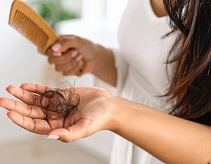Excessive Hair Shedding