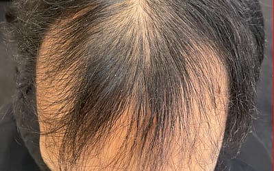 Taboo around male pattern hair loss