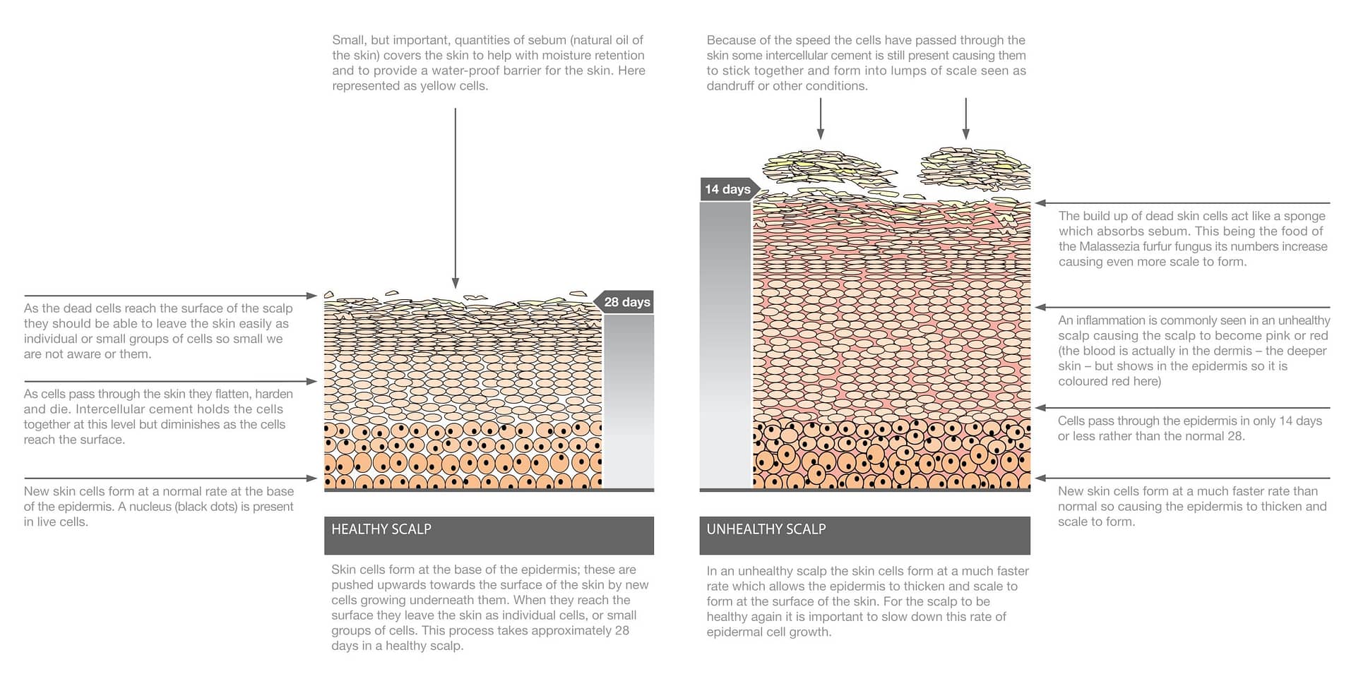 What is Seborrheic Dermatitis